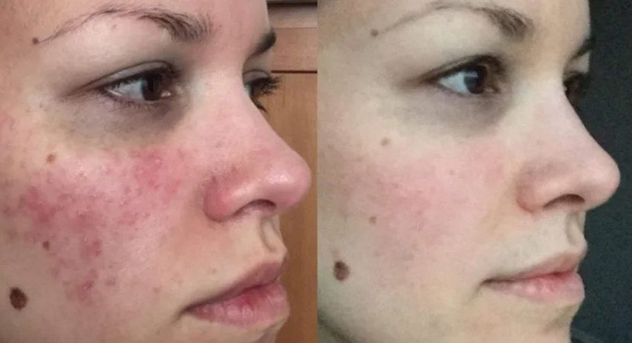6 Rosacea skin care tips dermatologists give their patients